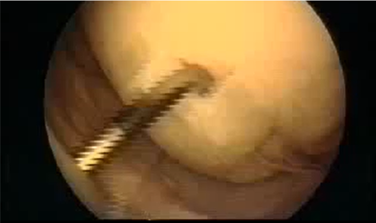 lesioni-cartilaginee-magnani